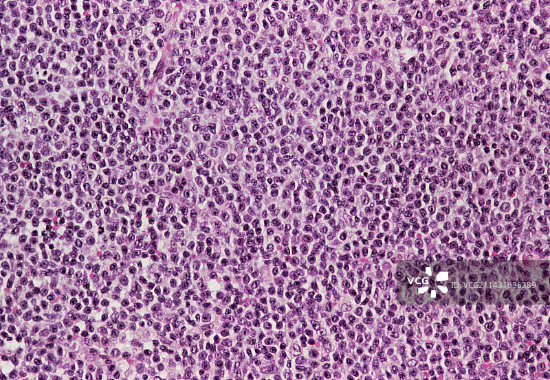 高级非霍奇金淋巴瘤彩色光学显微镜图片素材