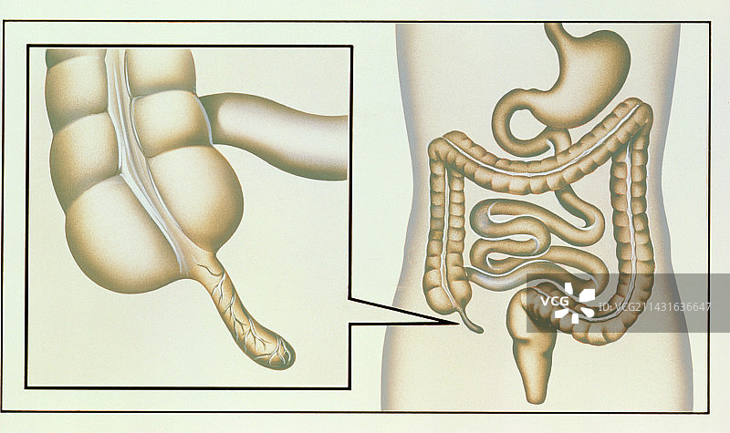 阑尾炎医学插画图片素材