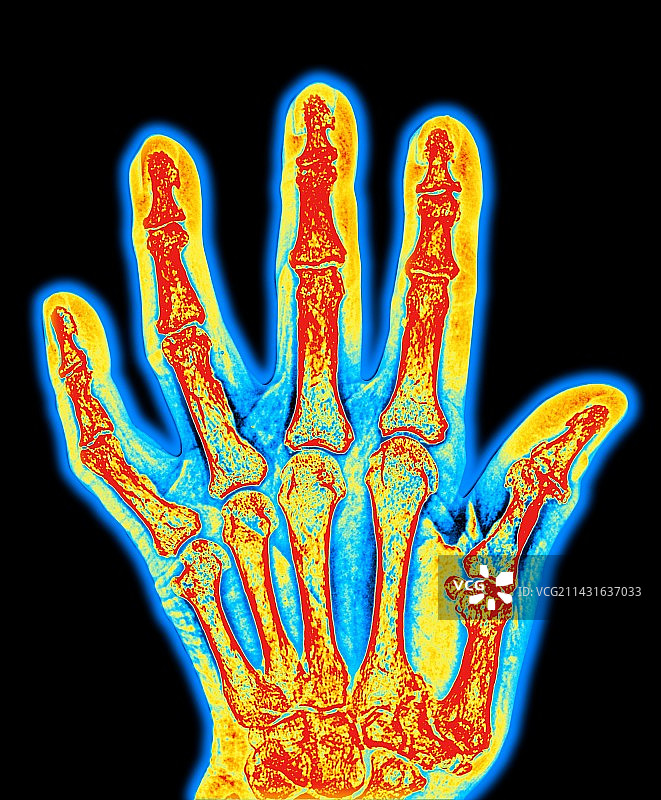患关节炎的手骨图片素材