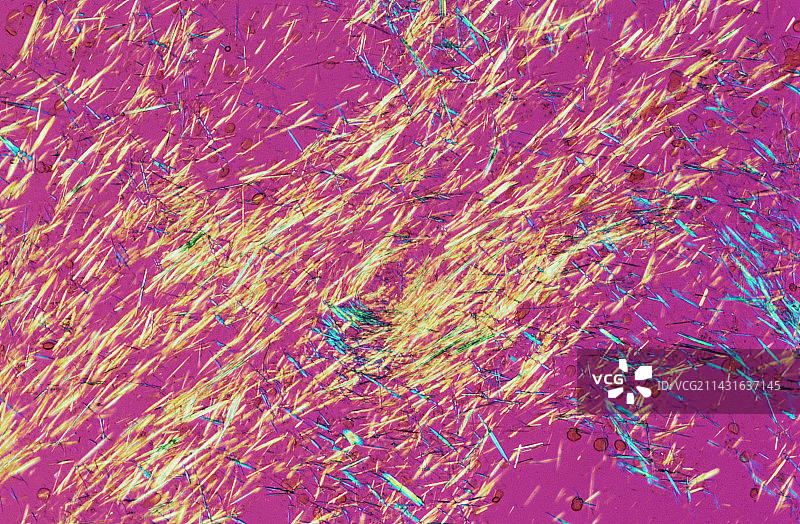 痛风结晶图片素材