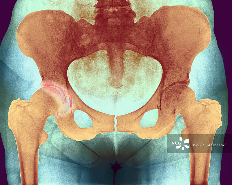 髋关节骨关节炎X光片图片素材