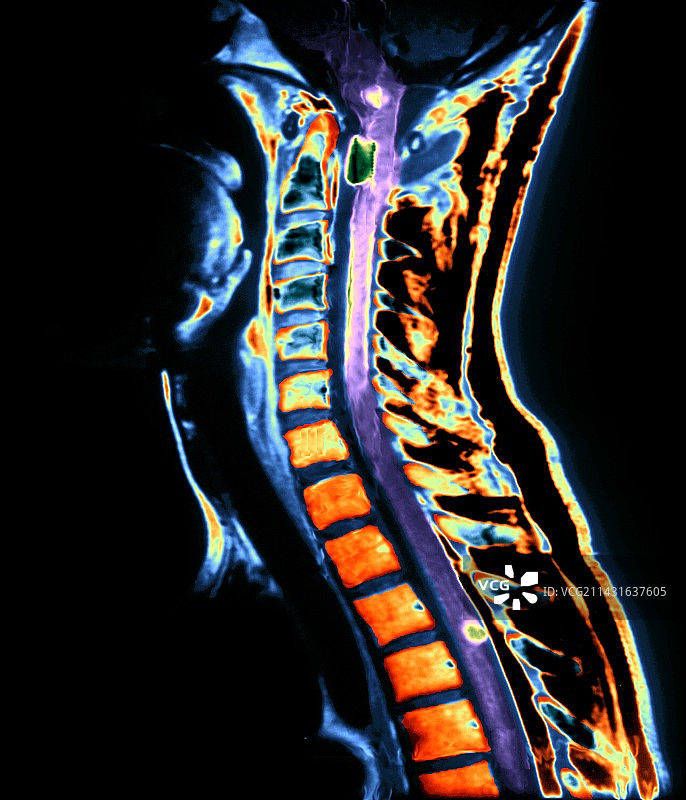 脊髓神经纤维瘤核磁共振扫描图片素材