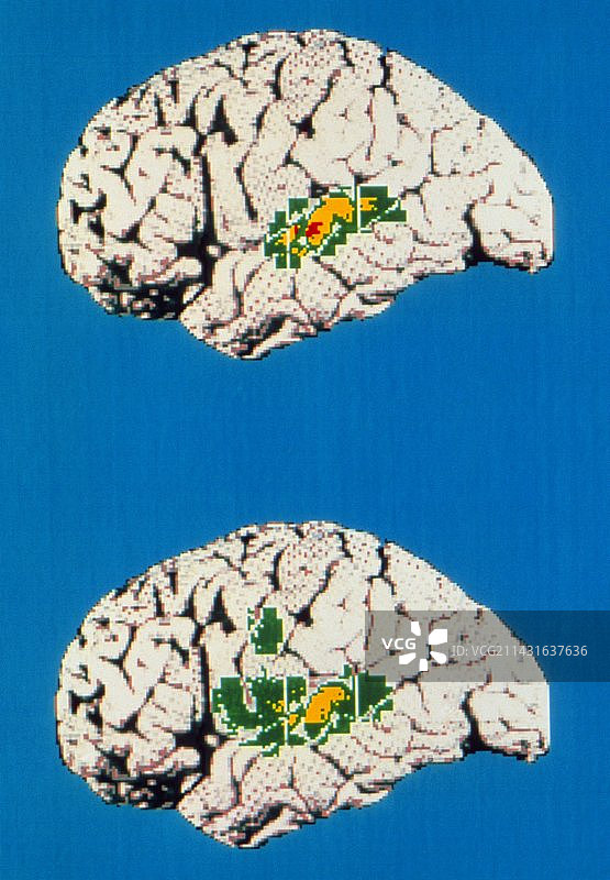 听/重复单词时的彩色PET脑部扫描图片素材