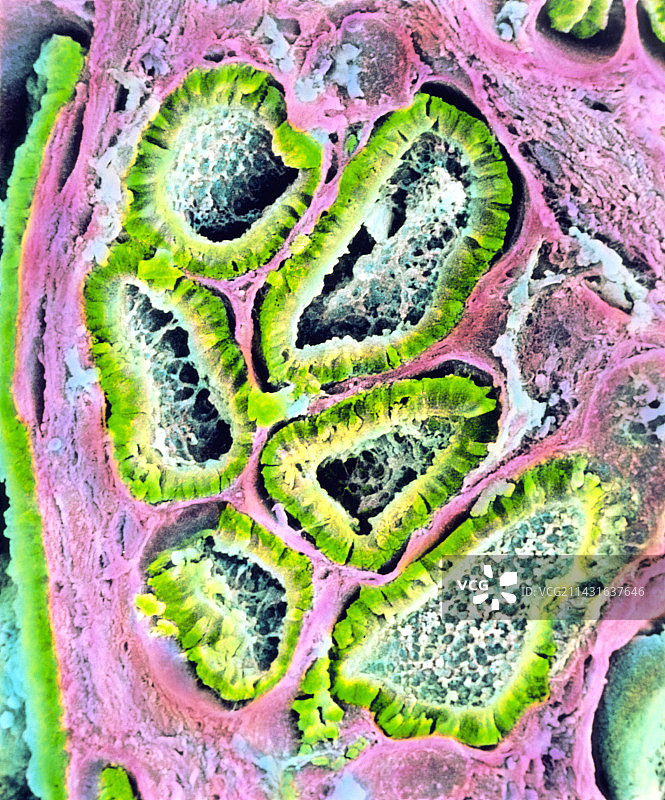 卵巢支持细胞-间质细胞瘤的彩色扫描电镜图图片素材