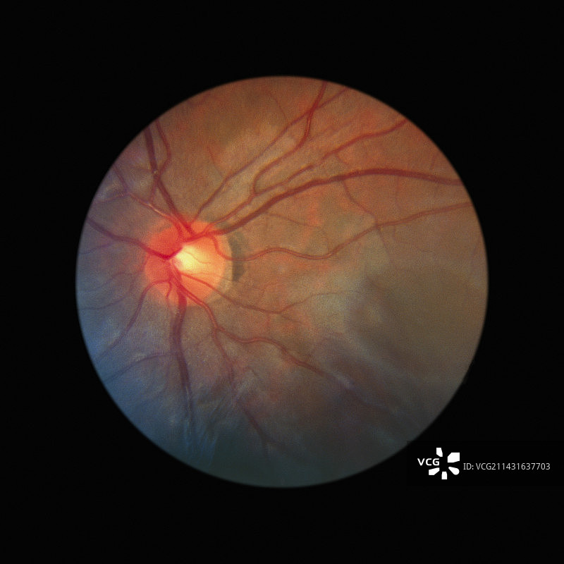 正常视网膜的眼底相机图像（亚洲人）图片素材