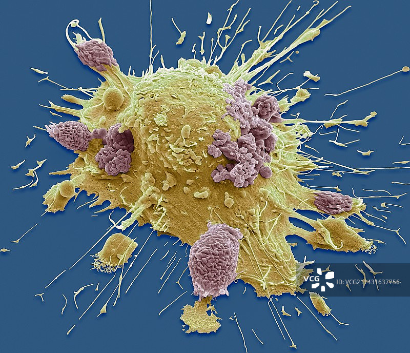 口腔癌细胞扫描电镜图图片素材