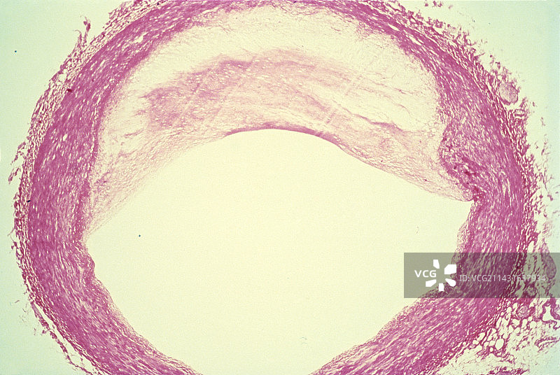 人体冠状动脉心脏切片图片素材