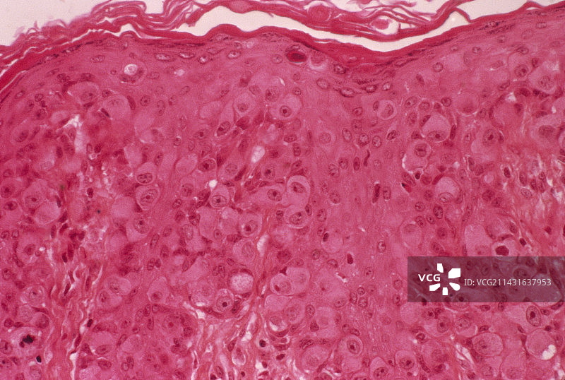 佩吉特乳腺病图片素材