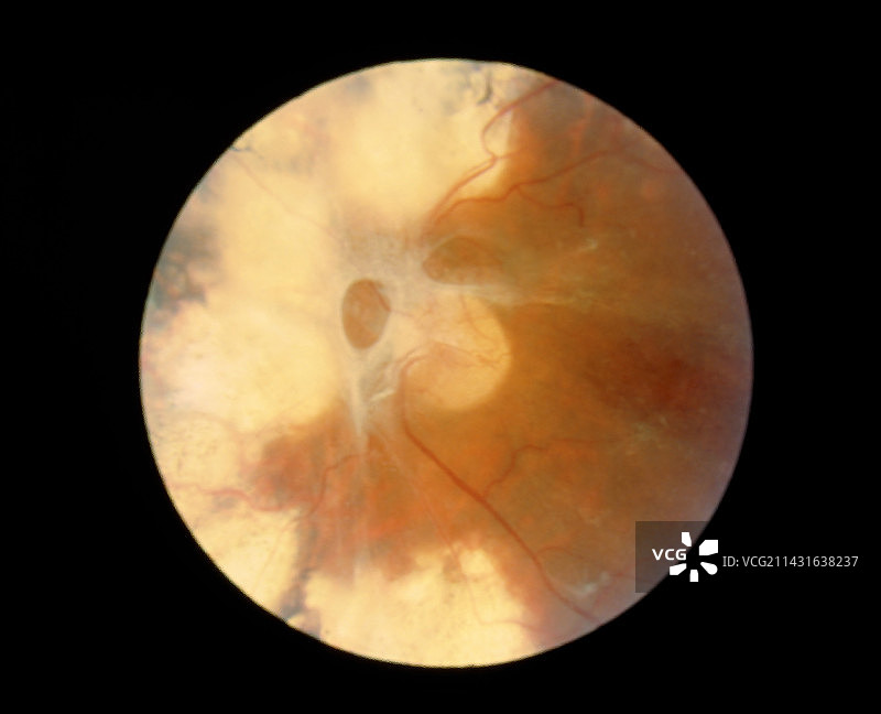 糖尿病视网膜病变眼底镜检查图片素材