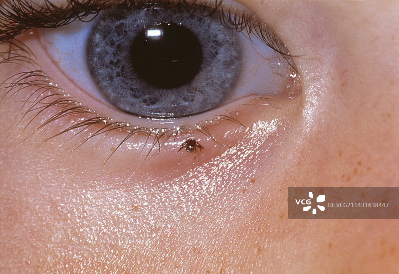 蜱虫吸食眼睑图片素材