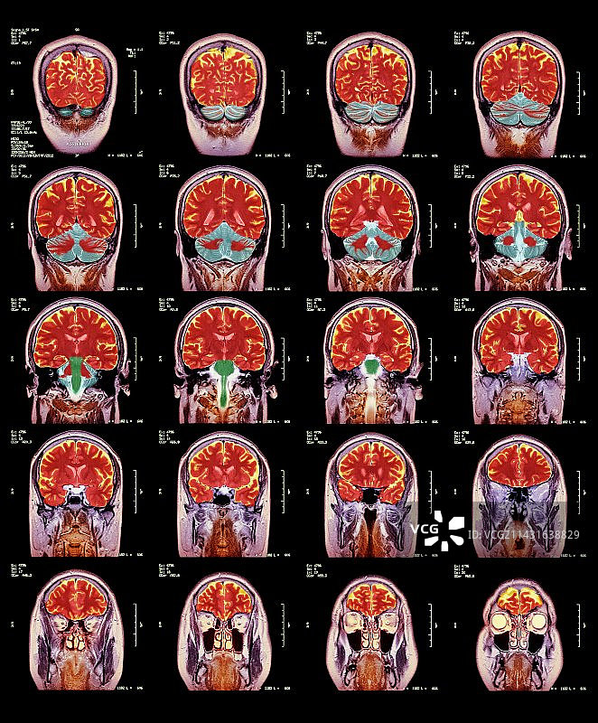 健康大脑核磁共振扫描图片素材