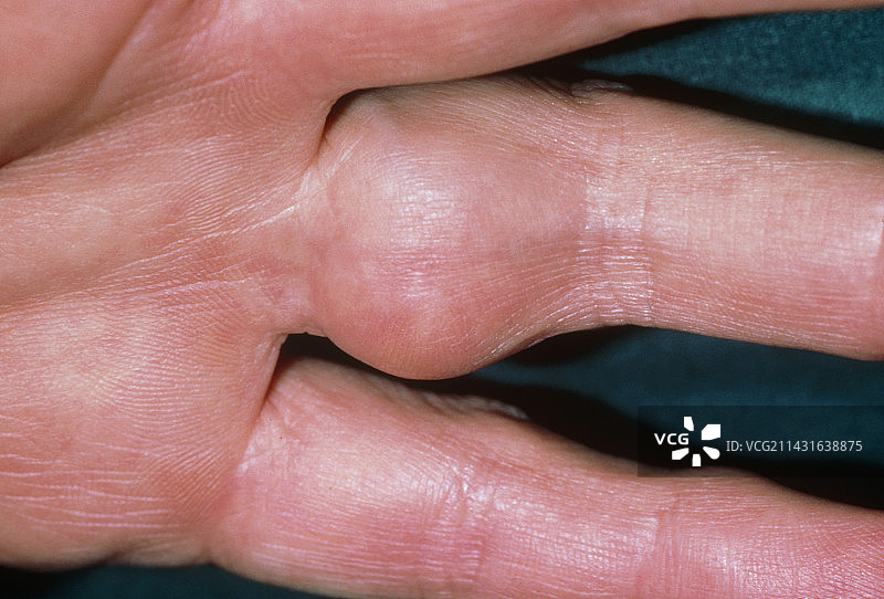 手指关节滑膜炎的临床照片图片素材