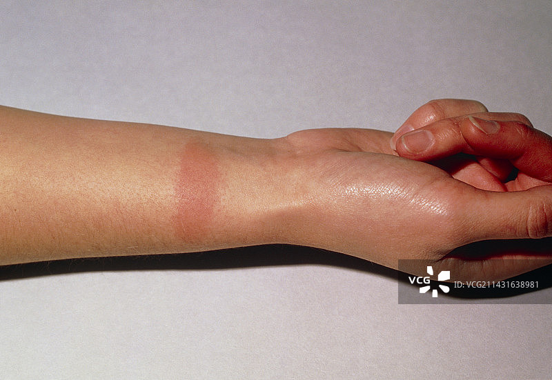 皮革腕带引起的过敏发红图片素材
