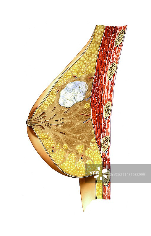 乳腺癌图片素材