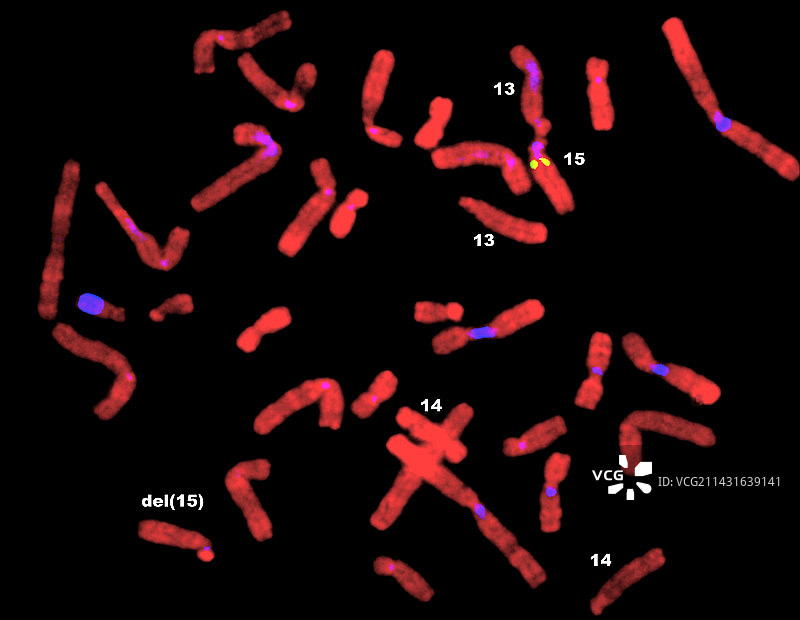 Prader-Willi染色体的FISH显微照片图片素材