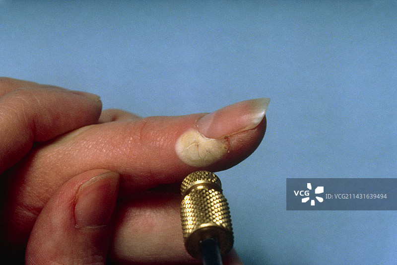 去除手指上的病毒疣图片素材