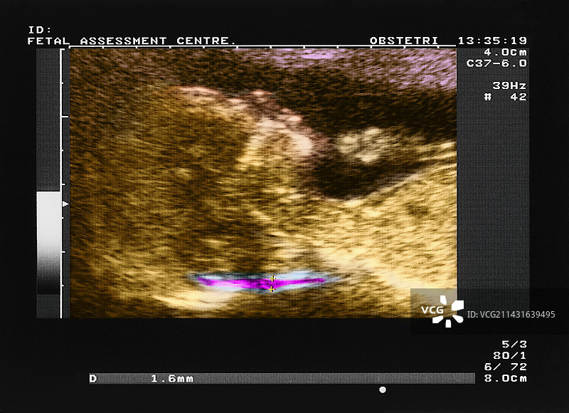 唐氏综合征NT扫描图片素材