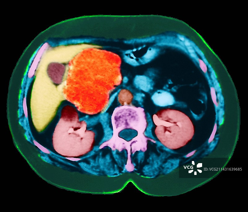 胰腺囊性肿瘤CT扫描图片素材