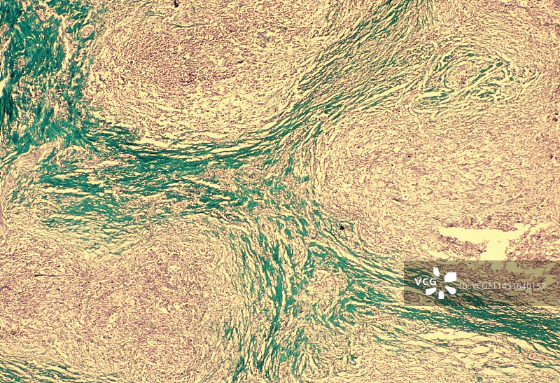 霍奇金病图片素材