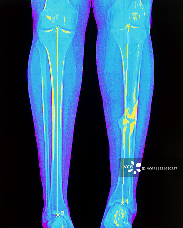 胫骨骨折的彩色X光片图片素材
