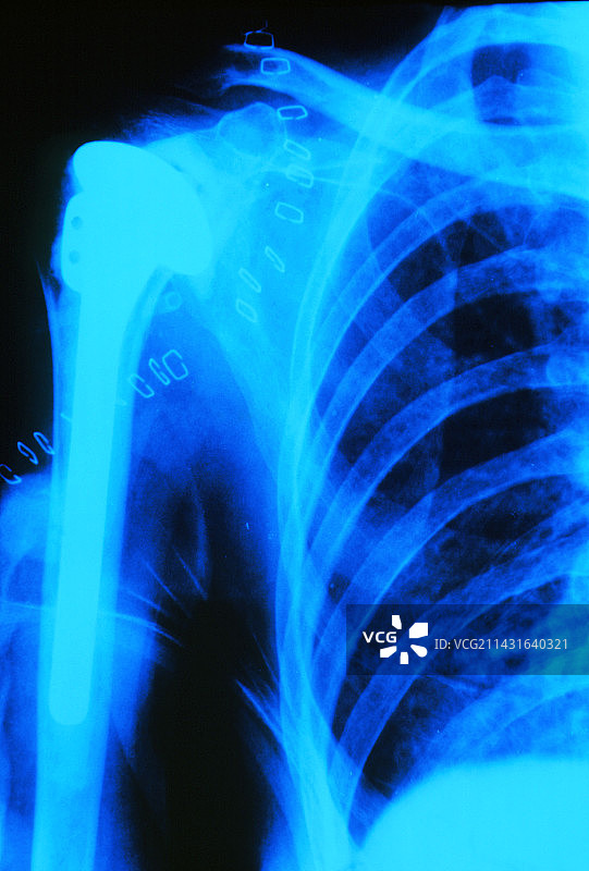 肩关节置换术的X光影像图片素材