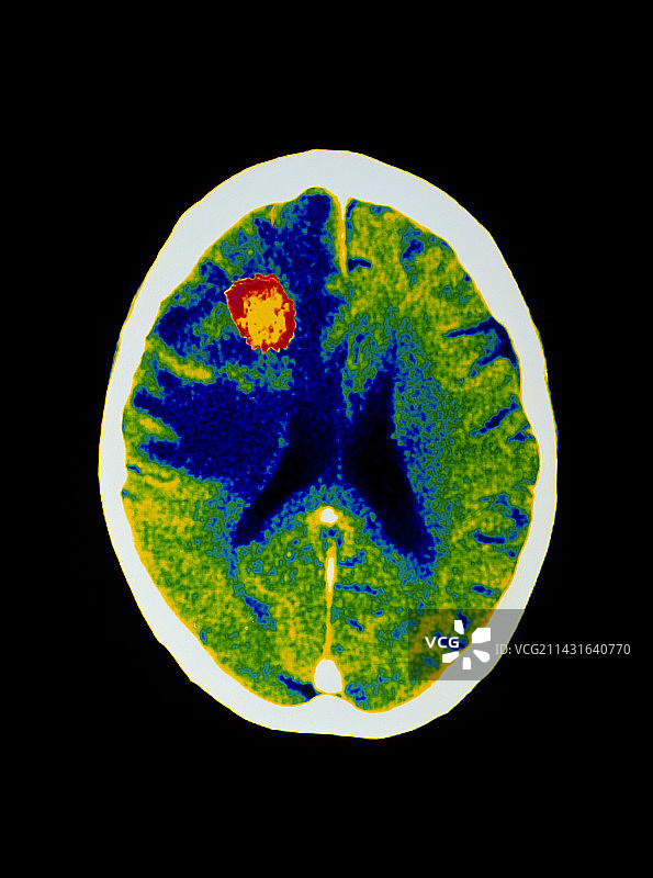 艾滋病患者脑脓肿的彩色CT扫描图片素材