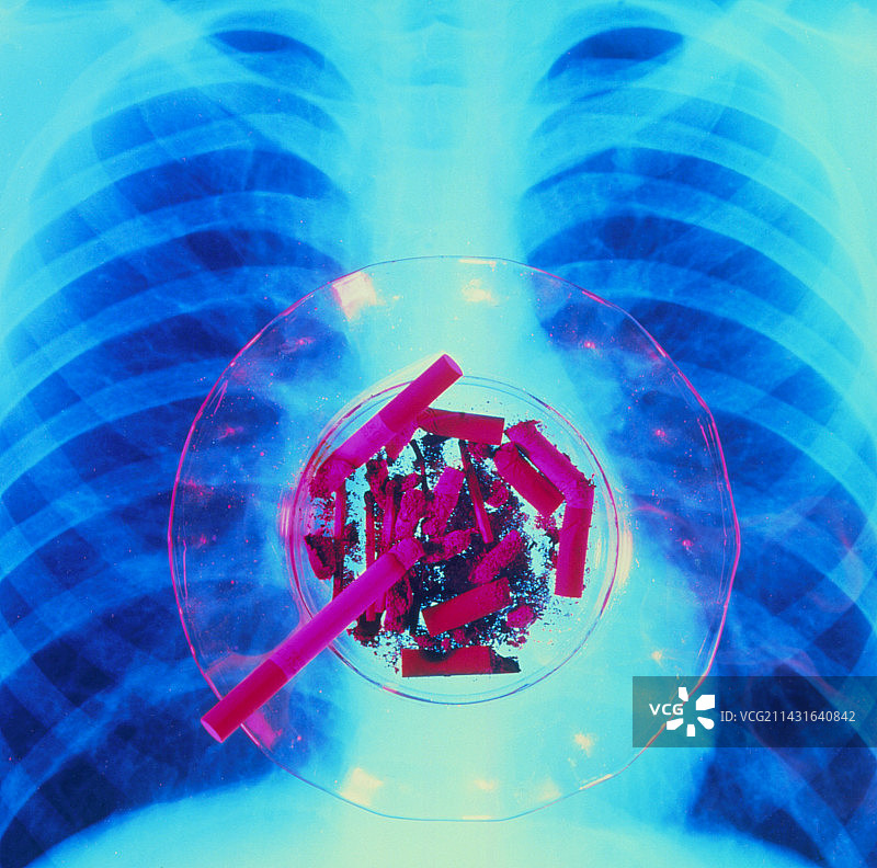 肺部X光片前的香烟图片素材