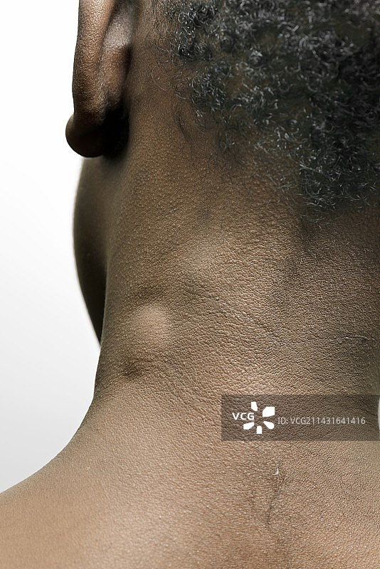 肿大的淋巴腺图片素材