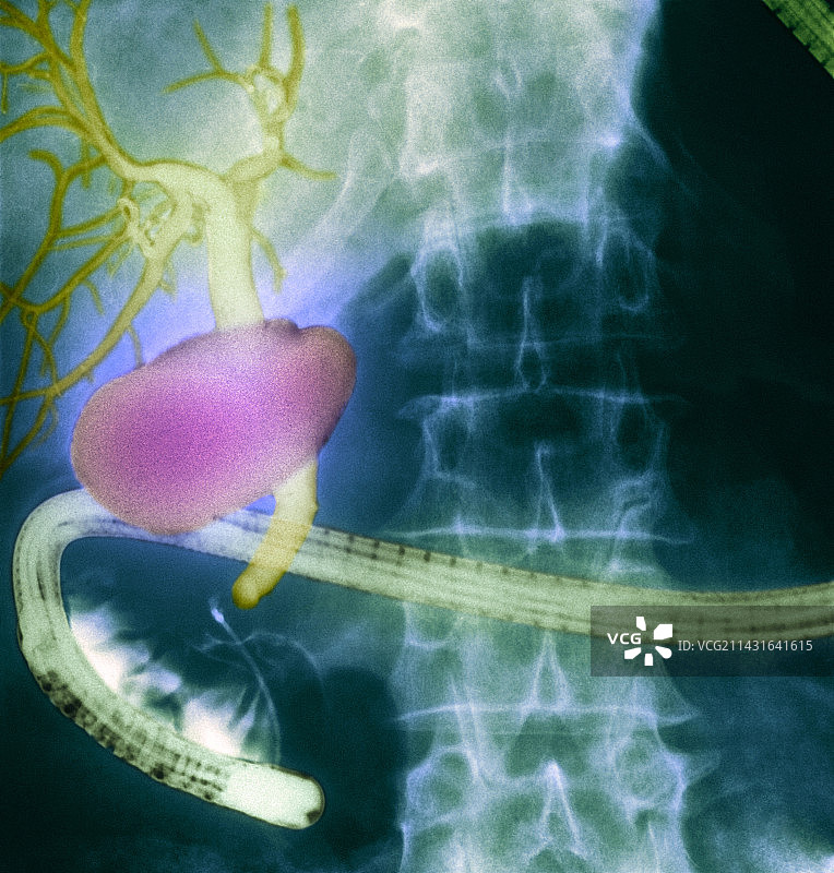 胆囊和胆管X光片图片素材