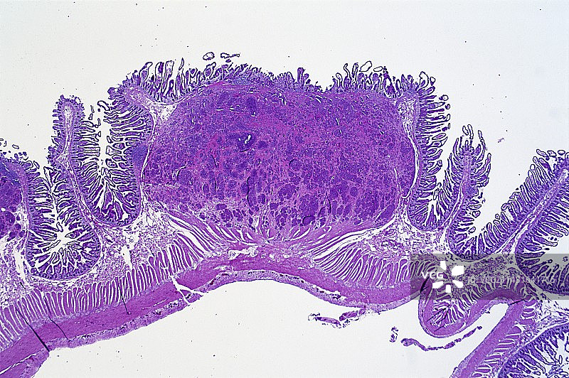 肠癌浅显显微照片图片素材