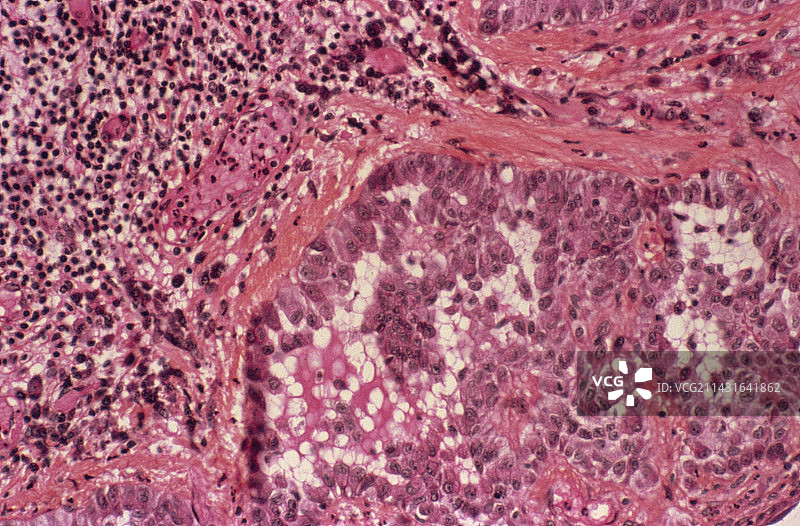 间皮瘤癌，光学显微照片图片素材