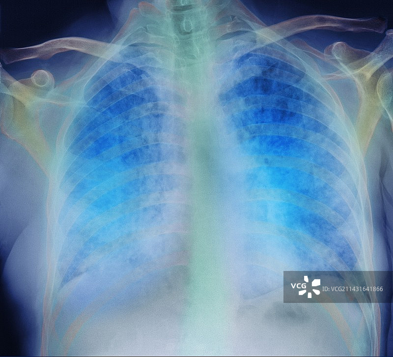 肺炎X光片图片素材