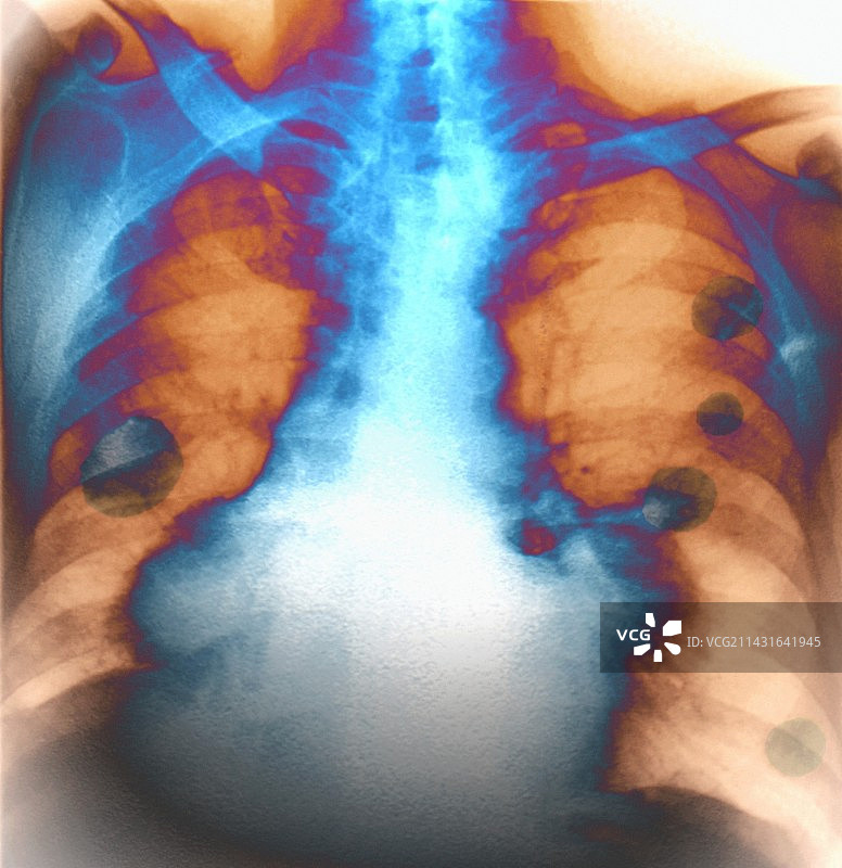 肺癌X光片图片素材