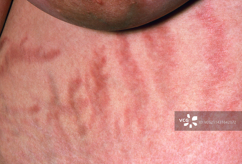 库欣综合征引起的妊娠纹图片素材