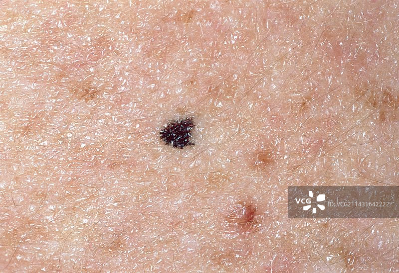 年轻男子皮肤上良性痣的特写图片素材