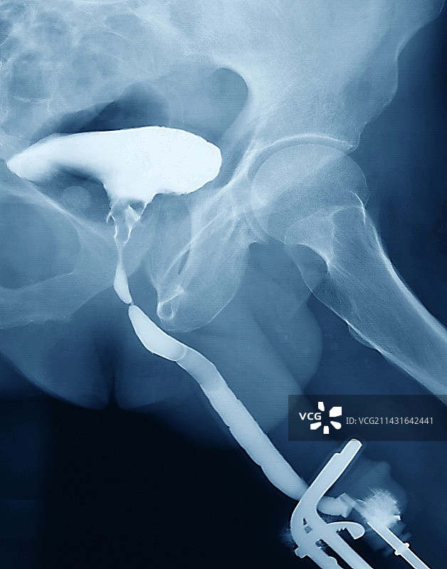 前列腺癌X光片图片素材