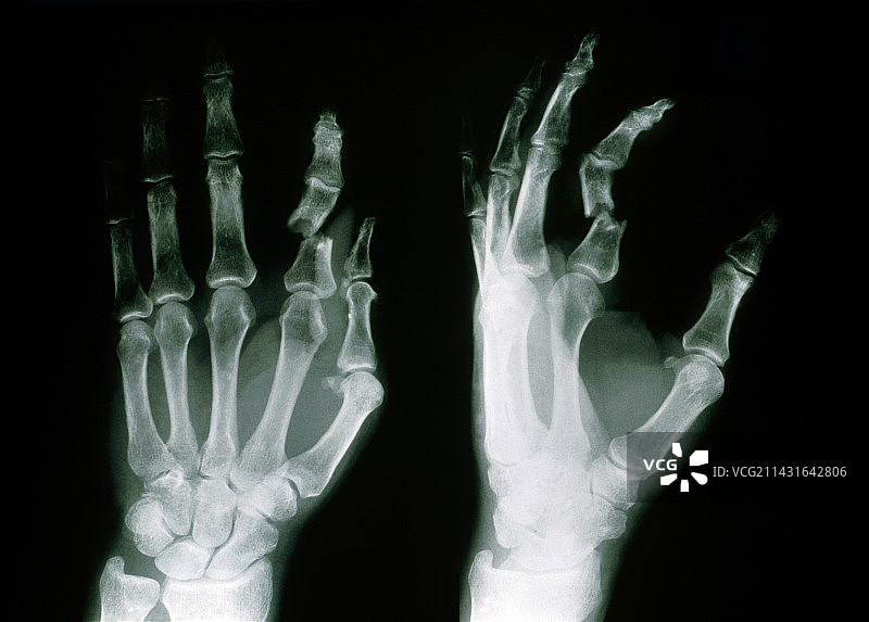 手部骨折的食指（指骨）X光影像图片素材