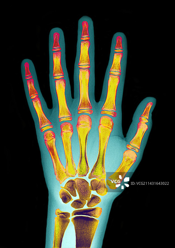 孩子的X光手部照片图片素材