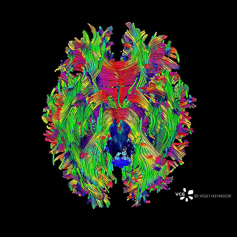 白质纤维DTI扫描图片素材