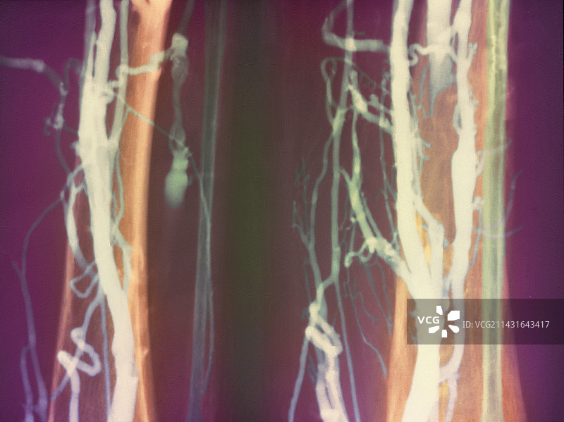 深静脉血栓X光片图片素材