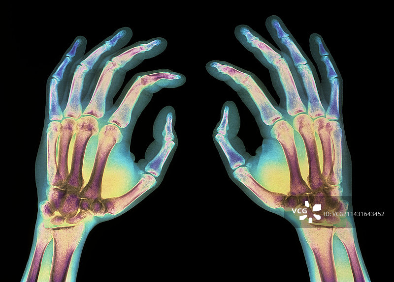 健康人手的彩色X光片图片素材