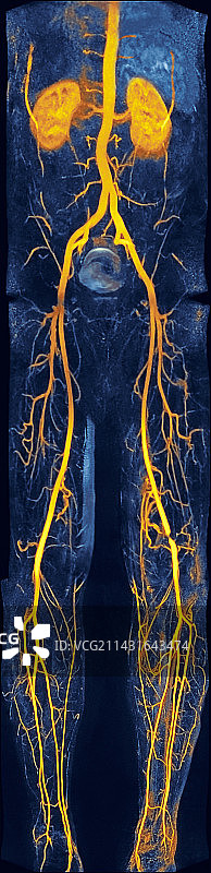 腿部动脉狭窄MRA扫描图片素材