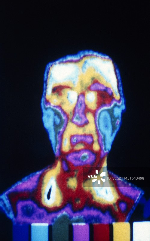 严重偏头痛热成像图图片素材
