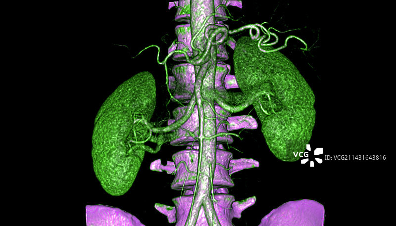 肾脏CT扫描图片素材