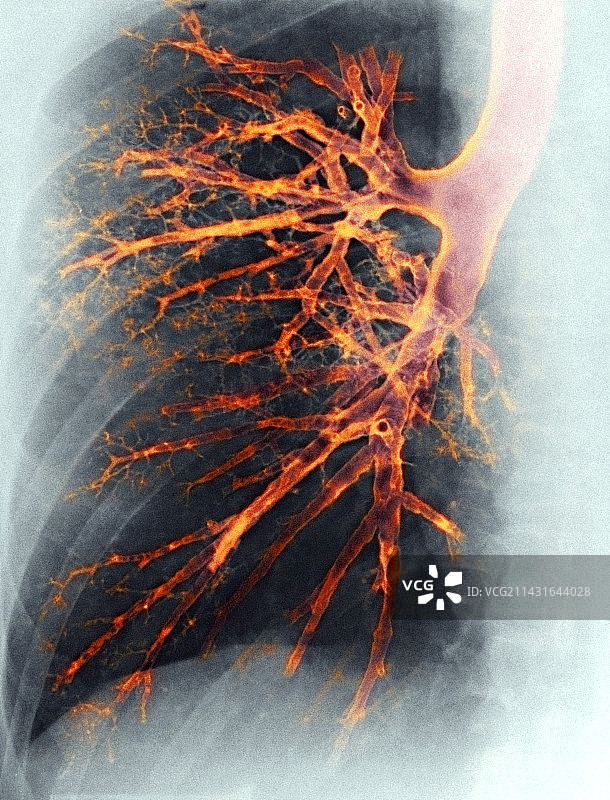 肺部X光片图片素材