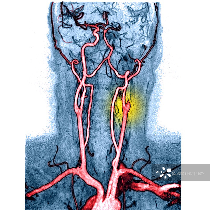 动脉阻塞血管造影图片素材