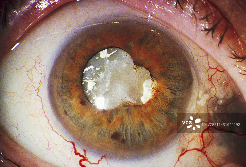 白内障图片素材