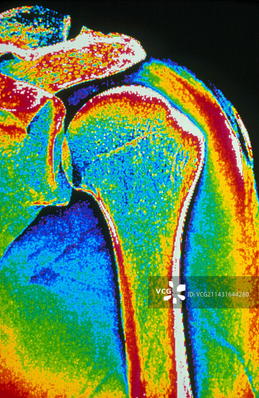 人肩关节彩色X光片图片素材