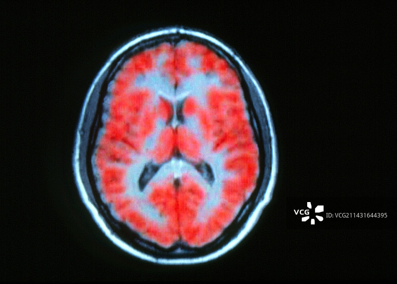 核磁共振脑部活动PET扫描图片素材
