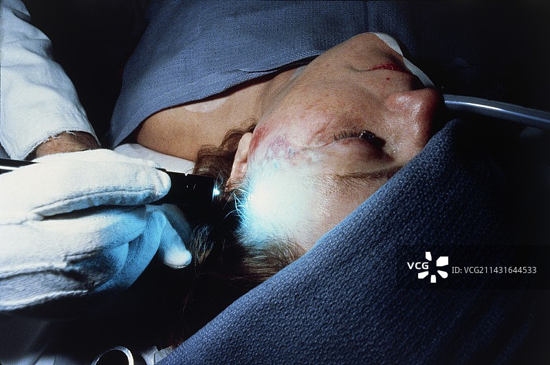 使用激光去除面部胎记图片素材